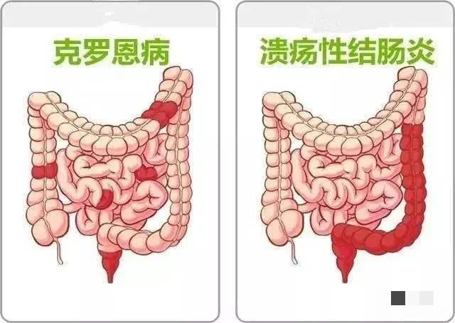 克罗恩病最新治疗方法，突破与挑战的交汇点探索