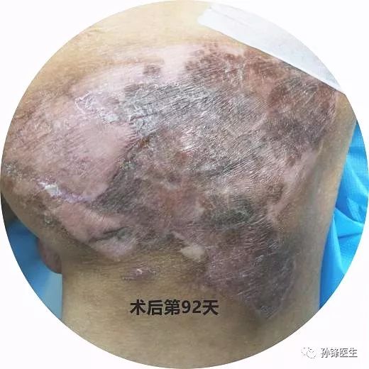 化脓性汗腺炎最新治疗进展研究综述